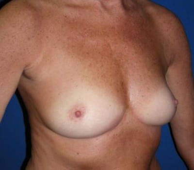 Before Image: 325cc Bilateral Silicone Gel Implant - other
