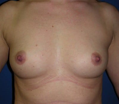 Before Image: 400cc Silicone Gel Implants - front