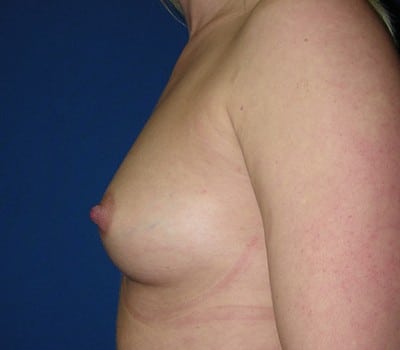 Before Image: 400cc Silicone Gel Implants - other