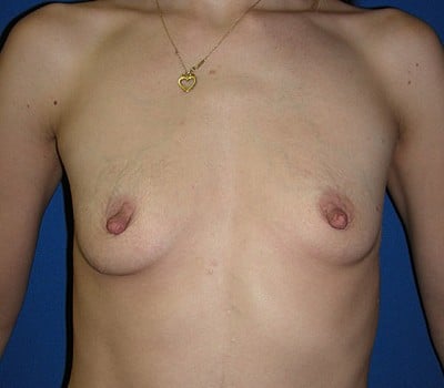 Before Image: 350cc Saline Implants - front