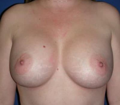 After Image: 450cc Bilateral Silicone Gel Implant - front