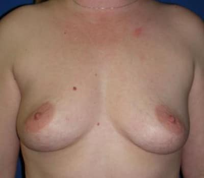 Before Image: 450cc Bilateral Silicone Gel Implant - front