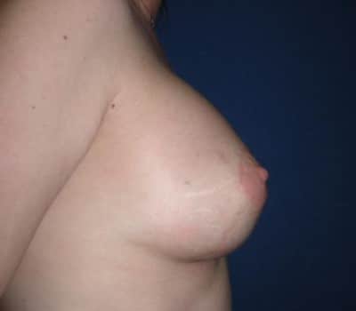 After Image: 450cc Bilateral Silicone Gel Implant - other
