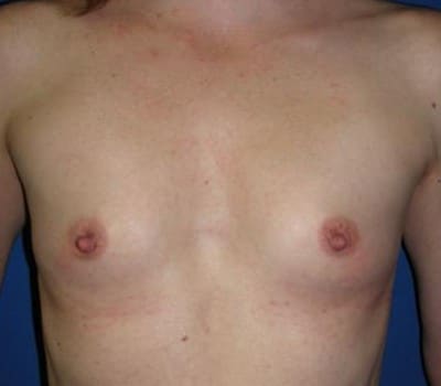 Before Image: Submuscular Breast Aug With Saline Implants - front