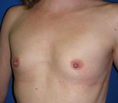Before Image: Submuscular Breast Aug With Saline Implants - other