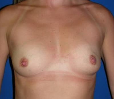 Before Image: 286cc Silicone Gel Implants - front