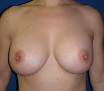 After Image: silicone gel implants - front