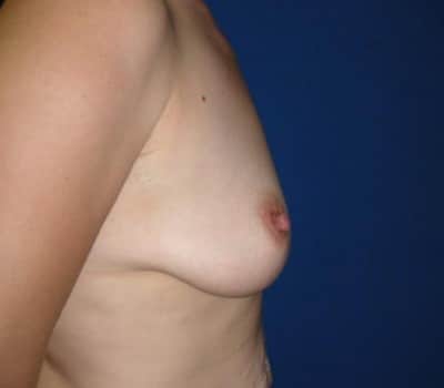 Before Image: silicone gel implants - other