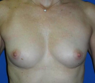 Before Image: 300cc Saline Implant - front