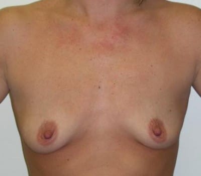 Before Image: Saline Implants 350cc Bilaterally - front