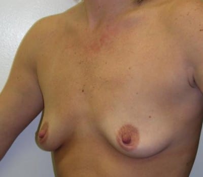 Before Image: Saline Implants 350cc Bilaterally - other