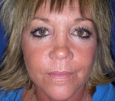 After Image: 52 Years Old Female - front
