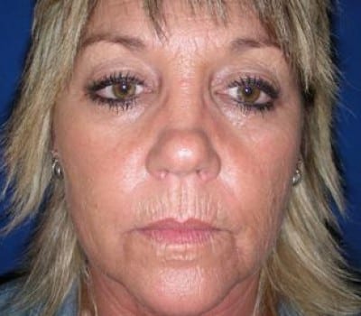 Before Image: 52 Years Old Female - front