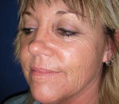 Before Image: 52 Years Old Female - other