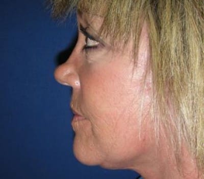After Image: 52 Years Old Female - other