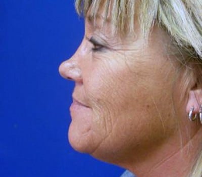 Before Image: 52 Years Old Female - other