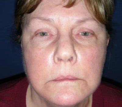 After Image: 62 Years Old - front