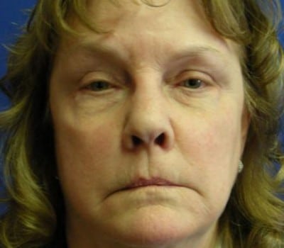 Before Image: 62 Years Old - front