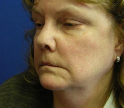 Before Image: 62 Years Old - other