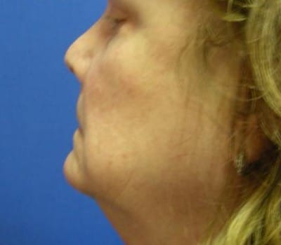 Before Image: 62 Years Old - other