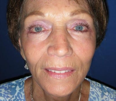 After Image: 69 Year Old Female - front