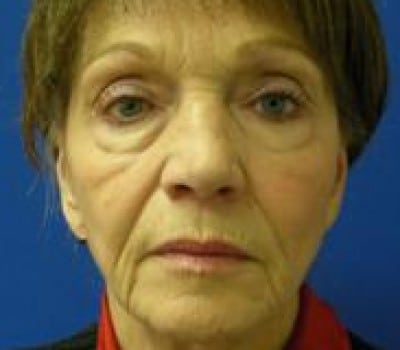 Before Image: 69 Year Old Female - front