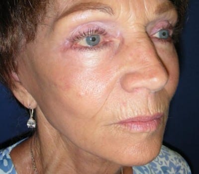 After Image: 69 Year Old Female - other