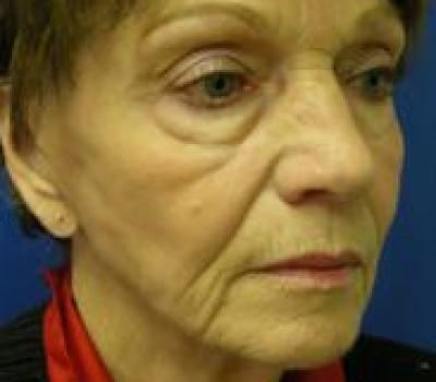 Before Image: 69 Year Old Female - other