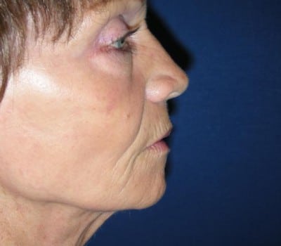 After Image: 69 Year Old Female - other