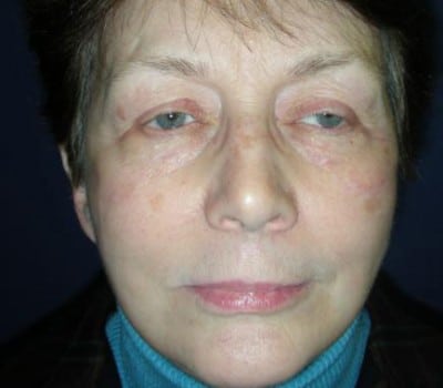After Image: MACS Face Lift - front