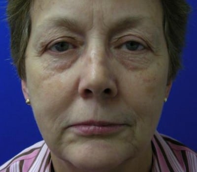 Before Image: MACS Face Lift - front