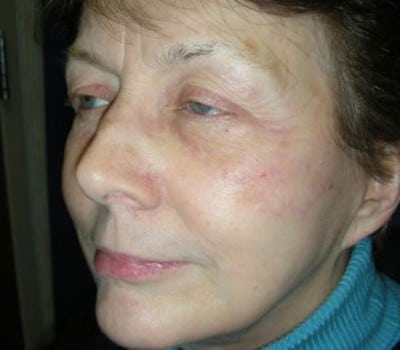After Image: MACS Face Lift - other
