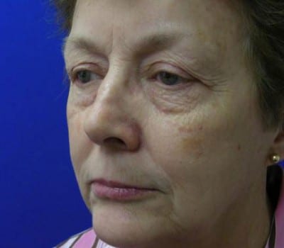 Before Image: MACS Face Lift - other