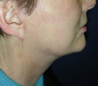 After Image: MACS Face Lift - other