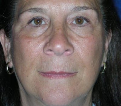 After Image: 63 year old female facial Rejuventation - front