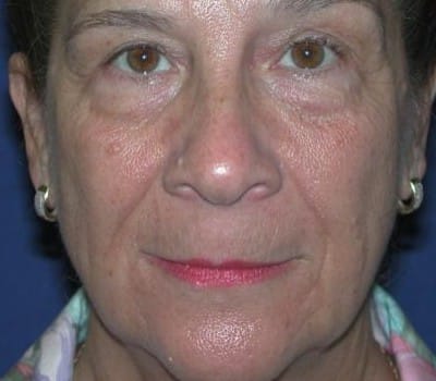 Before Image: 63 year old female facial Rejuventation - front