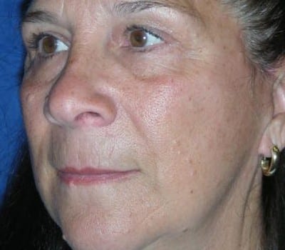 After Image: 63 year old female facial Rejuventation - other