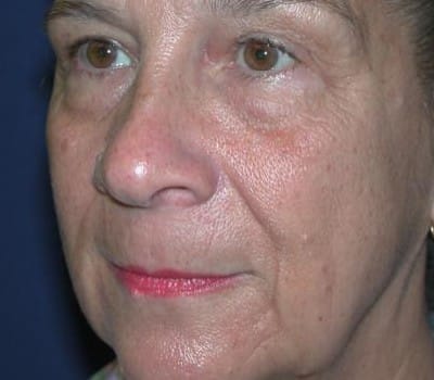 Before Image: 63 year old female facial Rejuventation - other