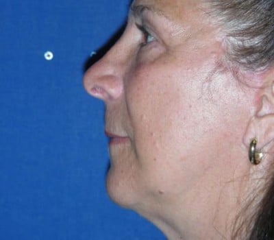 After Image: 63 year old female facial Rejuventation - other