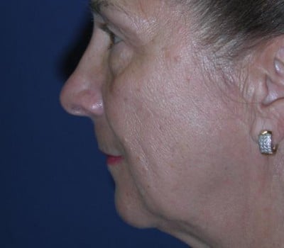 Before Image: 63 year old female facial Rejuventation - other