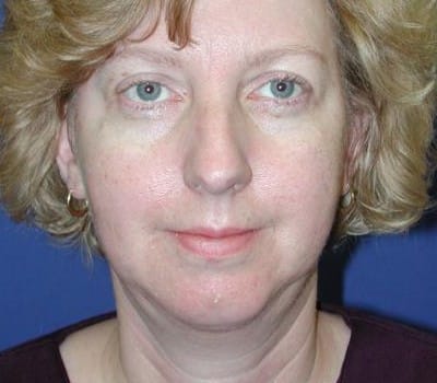 After Image: More Prominent Chin - front