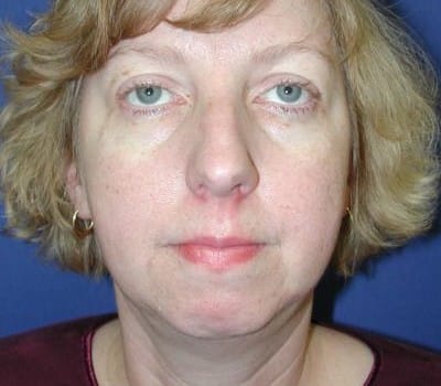 Before Image: More Prominent Chin - front