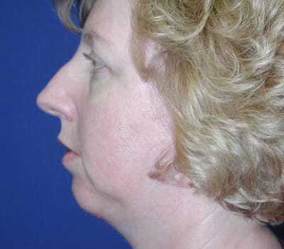 After Image: More Prominent Chin - other