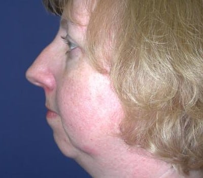 Before Image: More Prominent Chin - other