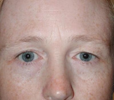 Before Image: 44 Years Old - other