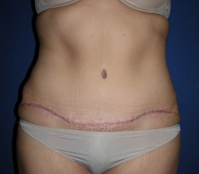 After Image: 3 Months Post-Op Abdominoplasty - front
