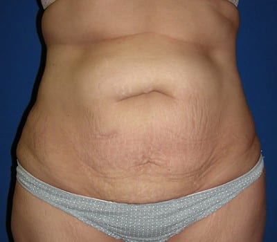 Before Image: 3 Months Post-Op Abdominoplasty - front