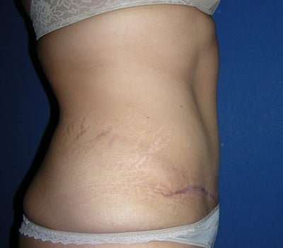 After Image: 3 Months Post-Op Abdominoplasty - other