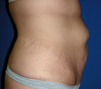 Before Image: 3 Months Post-Op Abdominoplasty - other