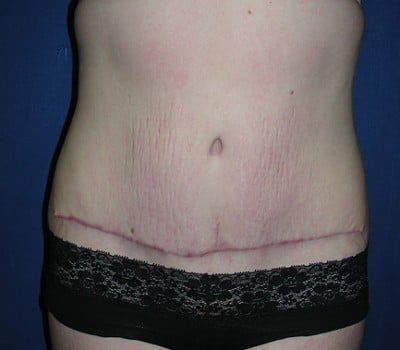 After Image: Abdominoplasty Simultaneous Gynecological Procedure - front